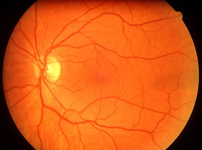 Retinal Imaging - A picture tells a thousand words