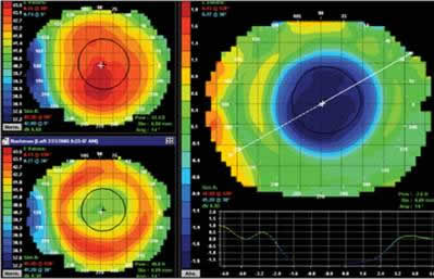 corneal topography 2